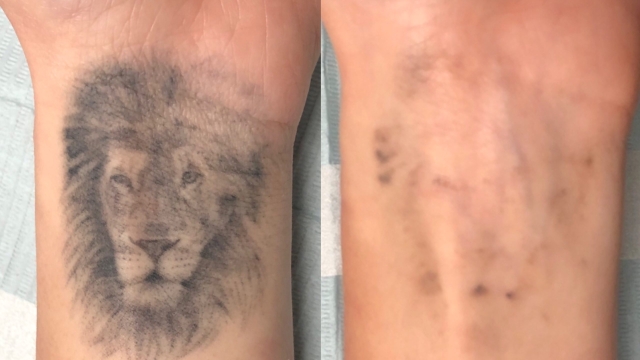 Tattoo Removal – What Methods Many