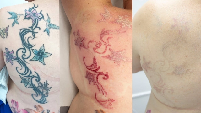 Why Back Tattoo Removal Is Growing In Number