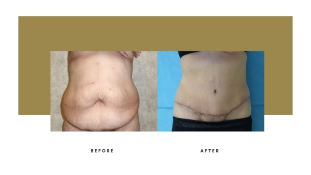 Flatten Your Tummy: The Ultimate Guide to Abdominoplasty