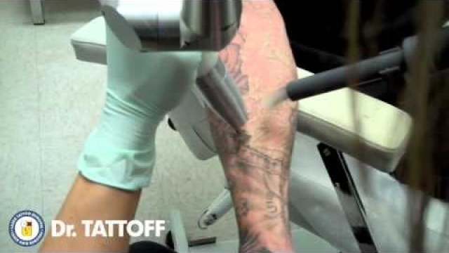 The Truth About Removing Tattoos