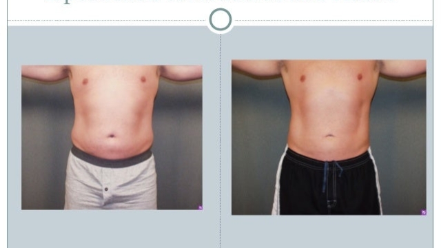 Trimming the Waistline: Unveiling the Secrets of a Tummy Tuck