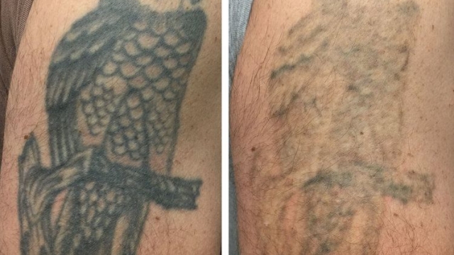 Info On Removing Colored Tattoo Ink