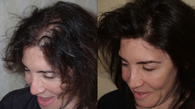 Transforming Thin Strands: Discover the Wonders of Hair Implants