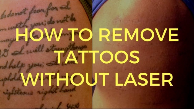 What Is Involved With Tattoo Removal?