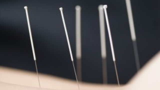 The Healing Art of Acupuncture: Restoring Balance and Promoting Well-being